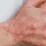 Atopická dermatitida